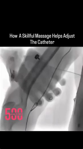 knowledge on Instagram: "A catheter is a soft, thin tube used in medical treatments ✅ In medical procedures, it’s not always machines that make the difference — it’s often human skill and sensitivity. During an angiographic exam, even a gentle massage can guide a catheter to the exact spot, improving both accuracy and safety. ✅ Angiography shows blood vessels using dye and imaging ✅ Popliteal artery is located behind the knee — hard to reach directly ✅ Skilled massage helps guide the catheter ge