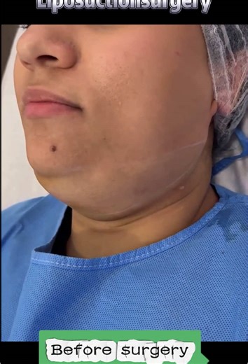 Liposuction Before and After Transformations