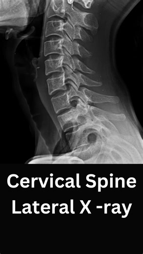 Dr Sameer Shelavale (MBBS,MS) on Instagram: "This is how I read a cervical spine X-ray in my OPD. Before looking for fractures or problems, it’s important to know what normal looks like. On a lateral view, alignment matters more than anything else smooth vertebral lines, maintained disc spaces, and overall balance. • cervical spine X-ray lateral • normal cervical spine X-ray • X-ray interpretation • spine alignment • OPD X-ray reading #CervicalSpineXray #XrayInterpretation #Orthopaedics #Radiolo