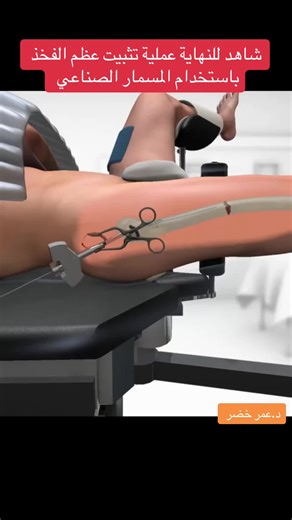 عملية تثبيت عظم الفخذ بالمسمار النخاعي (Femoral Nailing) هي طريقة حديثة وقوية لعلاج كسور عظم الفخذ، وخصوصاً الكسور الشديدة أو الناتجة عن حوادث. خلينا نشرحها بشكل بسيط شنو المشكلة؟ عظم الفخذ هو أطول وأقوى عظم بالجسم، لكن إذا انكسر (بسبب حادث سيارة مثلاً)، يكون الألم شديد وصعب يتحمل وزن الجسم. شنو يسوي الطبيب؟ بدل ما يفتح الجرح بشكل كبير، الطبيب يدخل مسمار معدني طويل وقوي داخل العظم نفسه (من الداخل)، وهذا المسمار: •يمر داخل قناة العظم (النخاع) •يثبت القطعتين المكسورتين بمكانهم •ينربط ببراغي من الأ