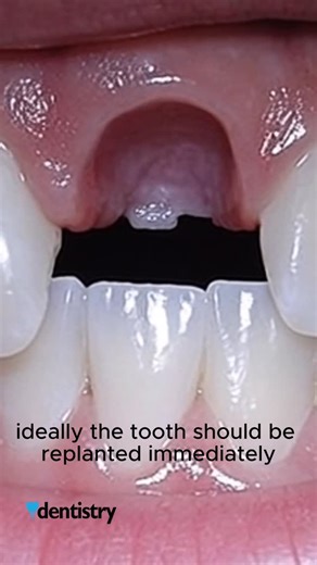 Dentistry on Instagram: "🦷 Dental Avulsion = REAL EMERGENCY 🚨 A tooth completely knocked out doesn’t always mean it’s lost. But what you do in the first minutes matters. ✔️ Immediate replantation is ideal ❌ Never let the tooth dry out 🥛 Milk is one of the best temporary storage media, supported by scientific evidence, because it helps preserve periodontal ligament cell viability ⚠️ Don’t scrub it. Don’t disinfect it. 👉 Place it in milk and get to a dentist immediately. ⏱️ Time + storage medi