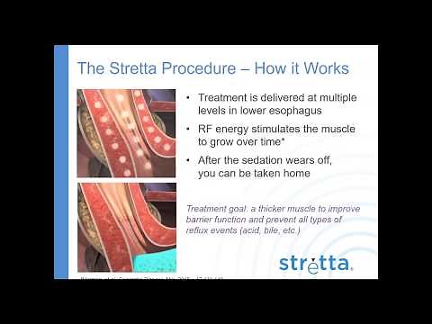 Stretta Patient Webinar 2017 Dr Reiss