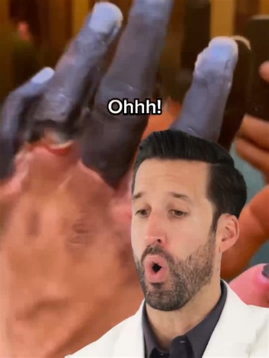 Doctor Reacts to Dry Gangrene Fingers | Doctor Reacts