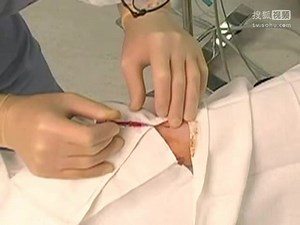 Placement of Arterial Line - NEJM_240P