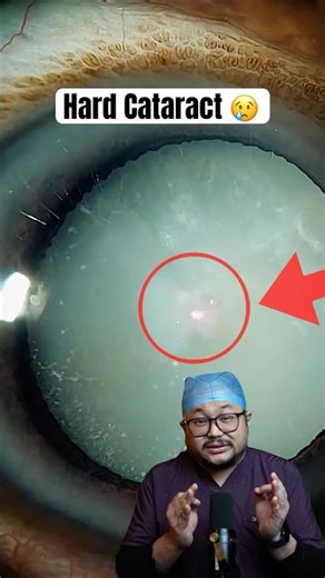 Milky white swollen cataract !! #eyes #facts #eyecare