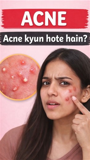 Why Acne Happens? #acne #pimples