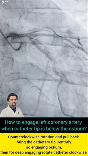 how to engage tiger catheter in left coronary artery during angiography?