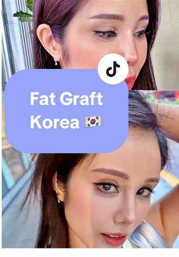 Natural Results from Facial Fat Grafting Procedure