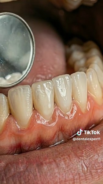 Cleaning Extreme Plaque – Thick plaque build up.