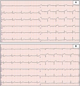 A novel treatment using a guide extension catheter and distal protection device for refractory coronary embolism: case report
