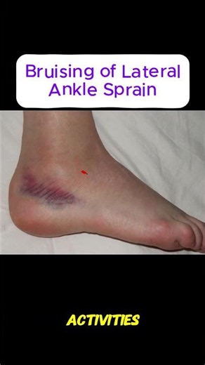 🦶 Lateral Ankle Complex Anatomy Explained #Anatomy #anklepain #physiotherapy #ATC #sportsmedicine
