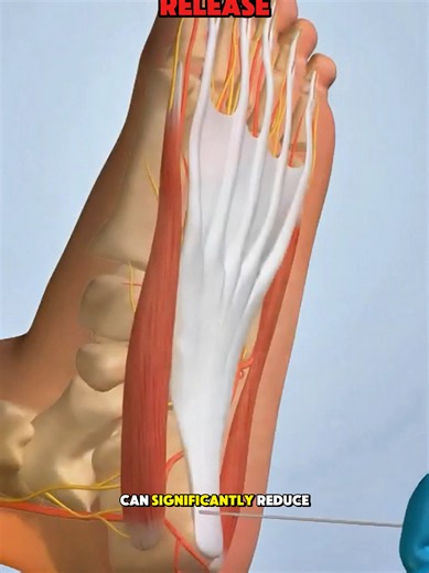 Plantar Fasciitis Release (3D Animation) #plantarfasciitis #release #tissue #foot #3danimation