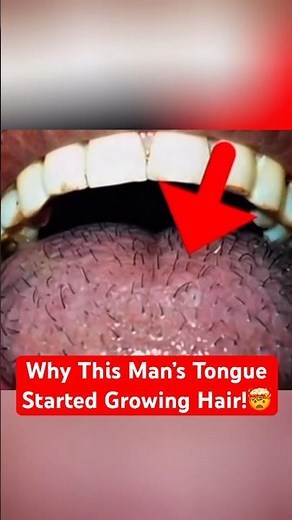 The Strange Condition Turning Tongues Black