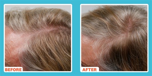 ‘I’m 70, And This At-Home Laser Device Helped Me Completely Regrow My Hair In Three Weeks’