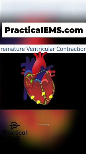 Spot PVCs on EKG: Your Quick Guide! #shorts