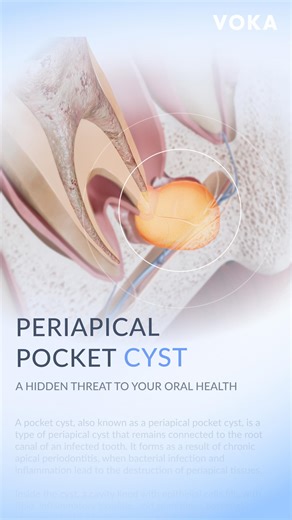 VOKA 3D Anatomy & Pathology on Instagram: "A pocket cyst, also known as a periapical pocket cyst, is a type of periapical cyst that remains connected to the root canal of an infected tooth. It forms as a result of chronic apical periodontitis, when bacterial infection and inflammation lead to the destruction of periapical tissues. 🔬 Inside the cyst, a cavity lined with epithelial cells fills with fluid, inflammatory exudate, and sometimes bacterial colonies. Unlike a true periapical cyst, which
