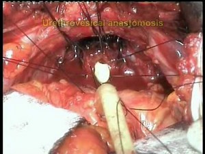 Radical Prostatectomy - Fast Continence Recovery • Video • MEDtube.net