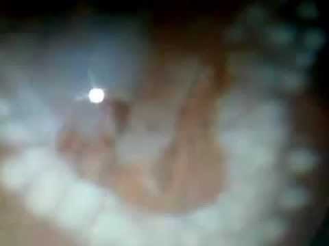 argon laser photocoagulation for retinal tear