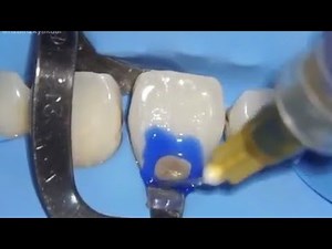 Class V composite Restoration || Direct anterior composite restoration