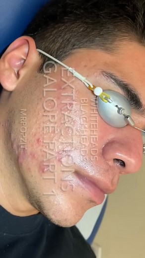 Part 2 : https://emmeacne.com/?p=4246 | Mr. PopZit 7