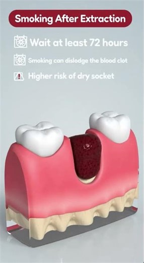 Wondering if you can smoke after a tooth extraction? 🚬🦷