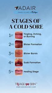 The five stages of a cold sore are: tingling, blister formation, blister bursts, scab formation, and healing. Each stage can last for several days, and the entire process usually takes two to three weeks. Learn more about your skin health, Click the link in my bio to book an appointment or call us today 602-567-7856 📆🩺 #familymedicine #primarycare #medicine #healthcare #doctor #health #physician #internalmedicine #medical #urgentcare #wellness #telemedicine #nursepractitioner #doctorsofinstagr
