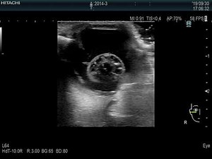 Retinal Detachment and posterior lens luxation in a dog by echo/ ultrasound（犬の網膜剥離、水晶体後方脱臼のエコー）