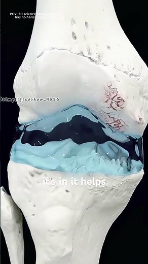Visco gel injection for treatment of knee osteoarthritis (3D animation) #medicalanimation #skeletal