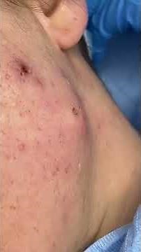 skin worms - Les Vers de Peau