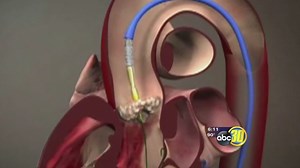 TAVR being called a game changer for cardiac surgery