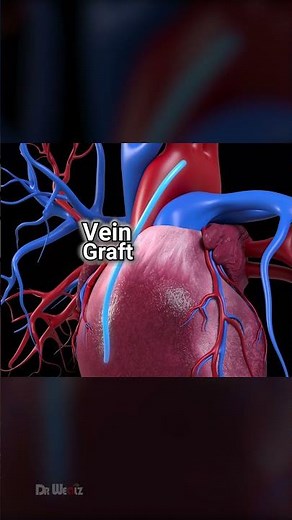 Double Bypass Heart Surgery #3danimation #healthcare #heart
