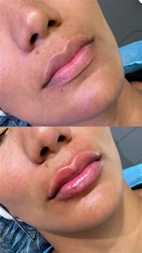 Bombshell Lips 💋 Ten tus labios de infarto 🥑👄🥑 Tecnica exclusiva en Dra. Segovia #labios #acido #estetica #lips #labial #makeup #gloss #fyp #potaxies🥑👄🥑