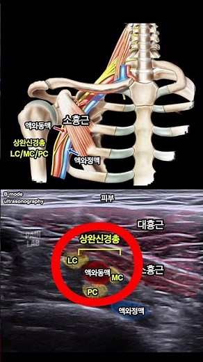 신경이 자극 받는 이유 #상완신경총