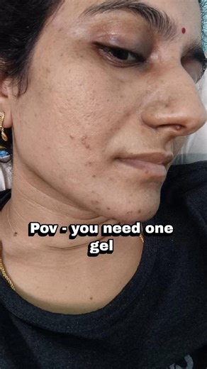 Best gel for acne marks | You need one gel to reduce acne and dark marks on face
