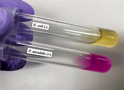 Health Knowledge Explorer on Instagram: "Urease Test: A Small Reaction with Major Diagnostic Value This image captures a classic contrast: 🦠 Proteus mirabilis — Urease Positive (+) ➡️ Urea is hydrolyzed into ammonia ➡️ pH rises ➡️ Phenol red indicator turns bright pink Clinical relevance: • Frequently implicated in complicated UTIs • Promotes alkaline urine • Associated with struvite (infection) stones • Important consideration in catheterized patients 🦠 Escherichia coli — Urease Negative (–)