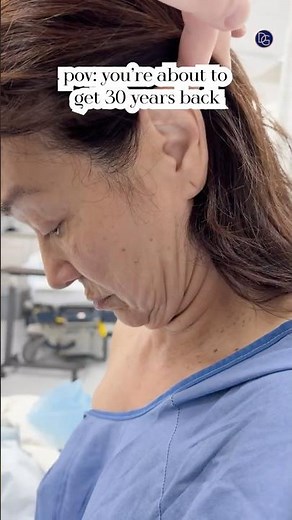 Deep Plane Face and Neck Lift| Before and After #beverlyhillsplasticsurgery #beforeandafter