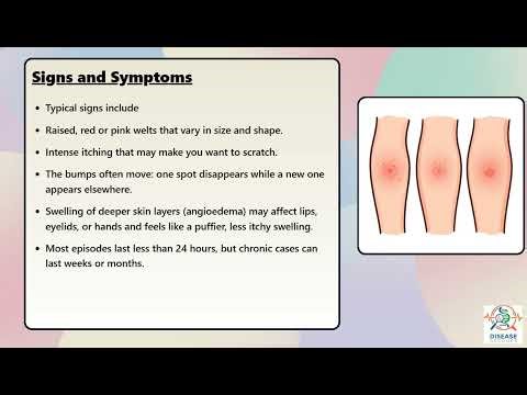 Urticaria (Hives) Explained Causes, Symptoms and Treatment, All Insights