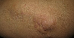 Granuloma anular: Una enfermedad con muchas caras