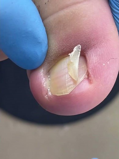 Easily trim ingrown toenails that are red and swollen! #nails