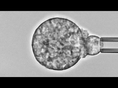 Human neutrophil versus Coccidioides (cause of Valley fever): Chemotaxis, adhesion, and phagocytosis