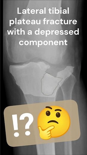 Lateral tibial plateau fracture