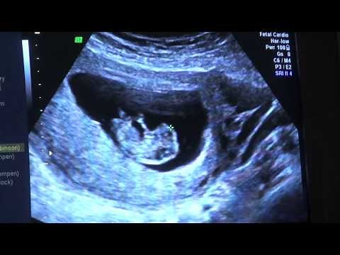 Embryon de 7 semaines