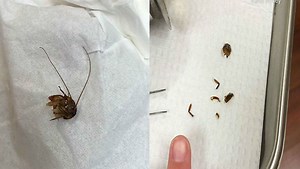 Florida woman awakes with cockroach in ear