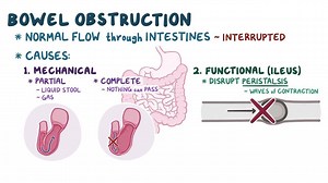 Video: Bowel obstruction - Video Explanation! | Osmosis | Osmosis