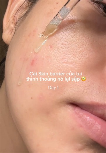 Effective Serums for Acne-Prone Skin: A Complete Guide