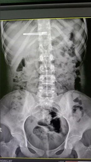 KUB x-ray