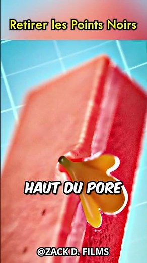 Comment fonctionne l'extraction des points noirs