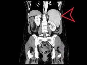 Abdomen Pelvis CT: Splenomegaly with marked Pancytopenia