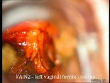 Colposcopia de vagina • Vídeo • MEDtube.es