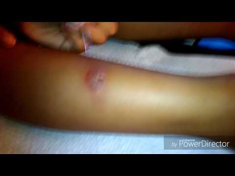 Popping Infected Spider bite blister